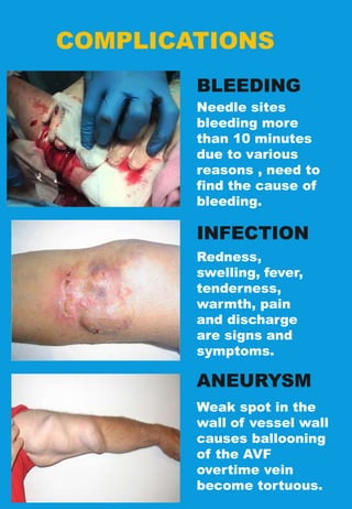COMPLICATIONS
Needle sites
bleeding more
than 10 minutes
due to various
reasons , need to
find the cause of
bleeding.
BLEEDING
INFECTION
ANEURYSM
Redness,
swelling, fever,
tenderness,
warmth, pain
and discharge
are signs and
symptoms.
Weak spot in the
wall of vessel wall
causes ballooning
of the AVF
overtime vein
become tortuous.
 