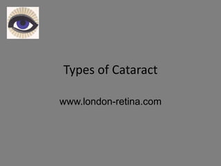 Types of Cataract

www.london-retina.com
 