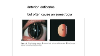 anterior lenticonus.
but often cause anisometropia
 