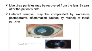 Live virus particles may be recovered from the lens 3 years
after the patient’s birth.
 Cataract removal may be complicated by excessive
postoperative inflammation caused by release of these
particles.
 