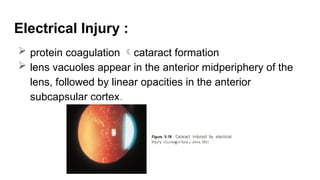 Electrical Injury :
 protein coagulation cataract formation
 lens vacuoles appear in the anterior midperiphery of the
lens, followed by linear opacities in the anterior
subcapsular cortex.
 
