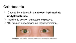 Galactosemia
 Caused by a defect in galactose-1- phosphate
uridyltransferase.
 Inability to convert galactose to glucose.
 “Oil droplet” appearance on retroillumination .
 