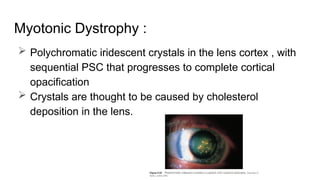 Myotonic Dystrophy :
 Polychromatic iridescent crystals in the lens cortex , with
sequential PSC that progresses to complete cortical
opacification
 Crystals are thought to be caused by cholesterol
deposition in the lens.
 