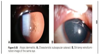 Types of cataract power point presentation