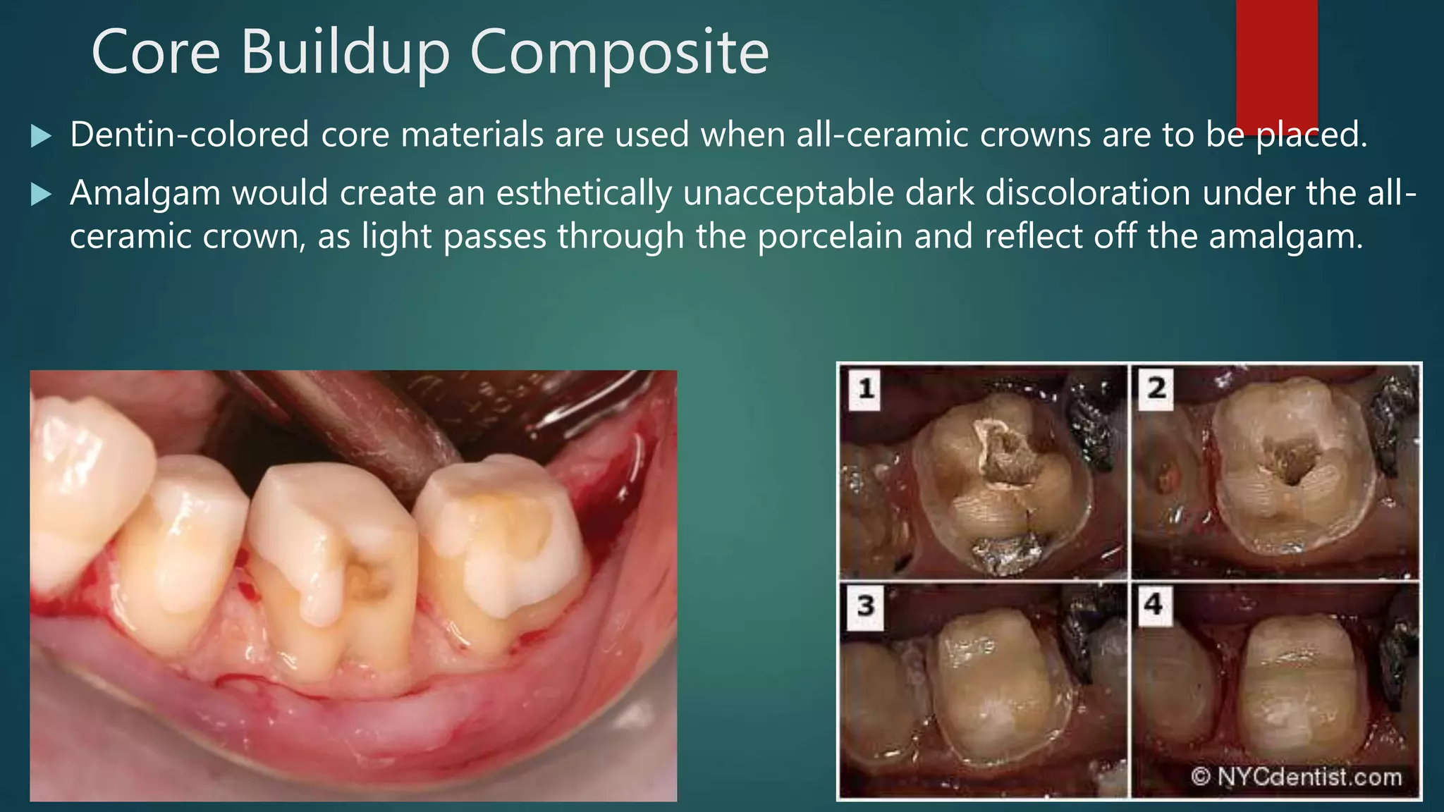 Core Buildup Composite
 Dentin-colored core materials are used when all-ceramic crowns are to be placed.
 Amalgam would create an esthetically unacceptable dark discoloration under the all-
ceramic crown, as light passes through the porcelain and reflect off the amalgam.
 