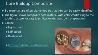 Core Buildup Composite
 BU materials are often pigmented so that they can be easily identified.
 The figure shows composite core material with color contrasting to the
tooth structure for easy identification during crown preparation.
 Can be:
Light-cured
Self-cured
Dual-cured
https://youtu.be/m7aDoKNSzec
 