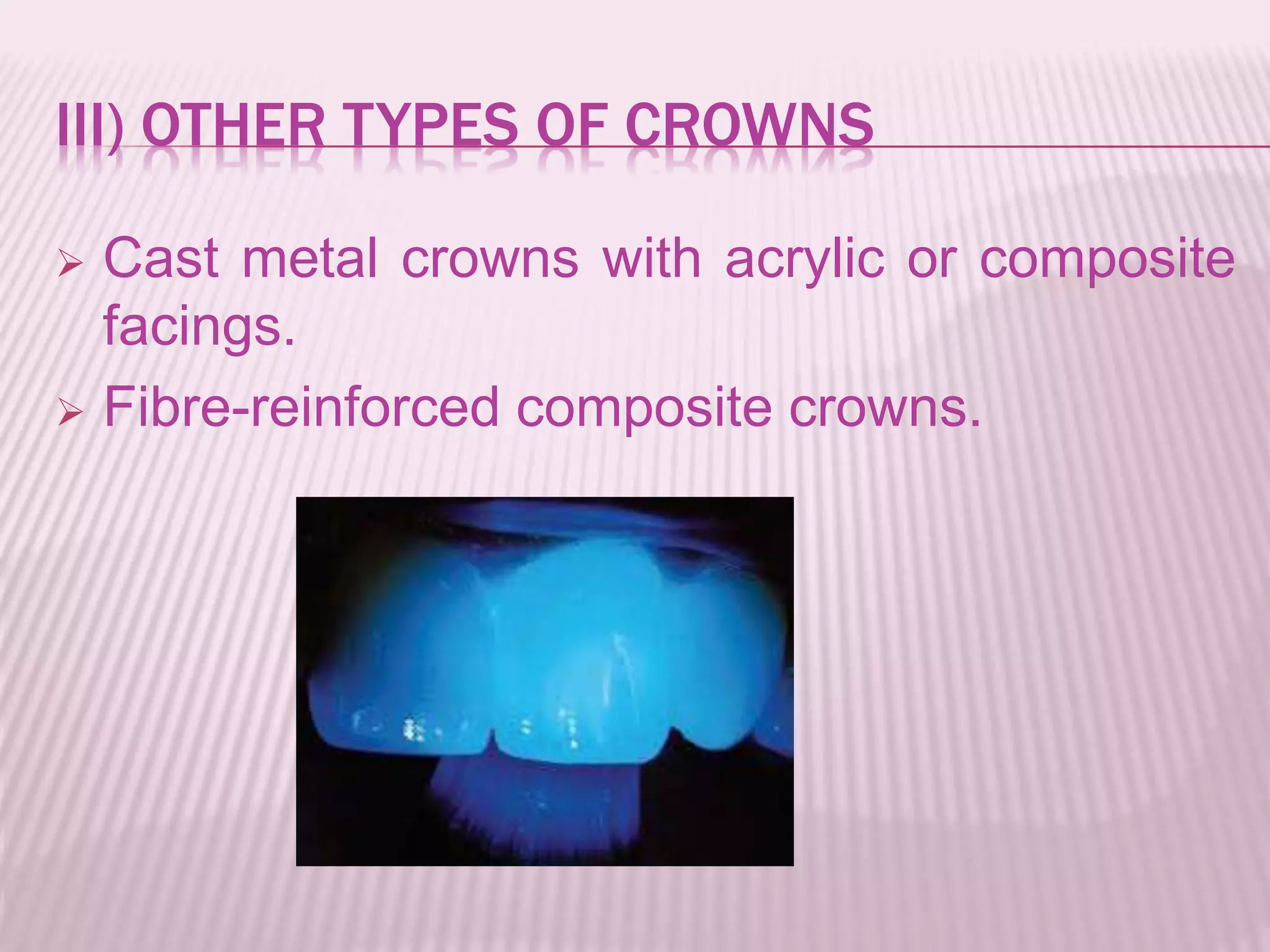 III) OTHER TYPES OF CROWNS 
 Cast metal crowns with acrylic or composite 
facings. 
 Fibre-reinforced composite crowns. 
 