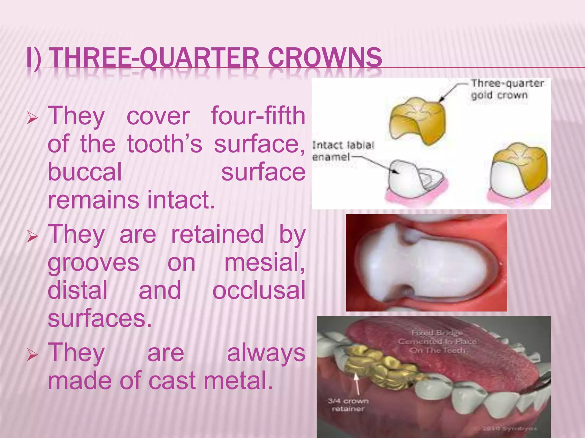 I) THREE-QUARTER CROWNS 
 They cover four-fifth 
of the tooth’s surface, 
buccal surface 
remains intact. 
 They are retained by 
grooves on mesial, 
distal and occlusal 
surfaces. 
 They are always 
made of cast metal. 
 