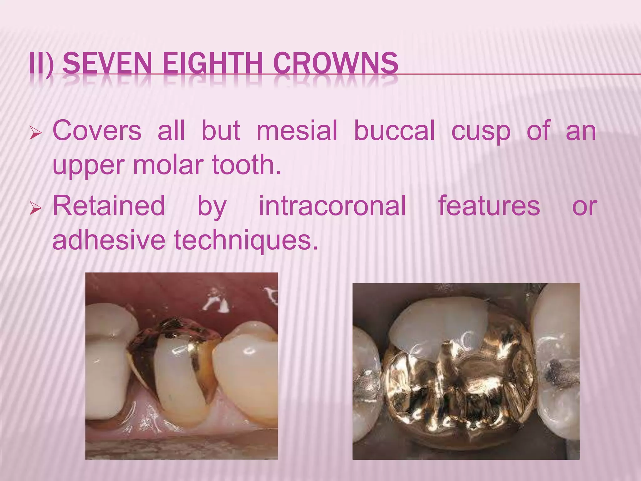 II) SEVEN EIGHTH CROWNS 
 Covers all but mesial buccal cusp of an 
upper molar tooth. 
 Retained by intracoronal features or 
adhesive techniques. 
 