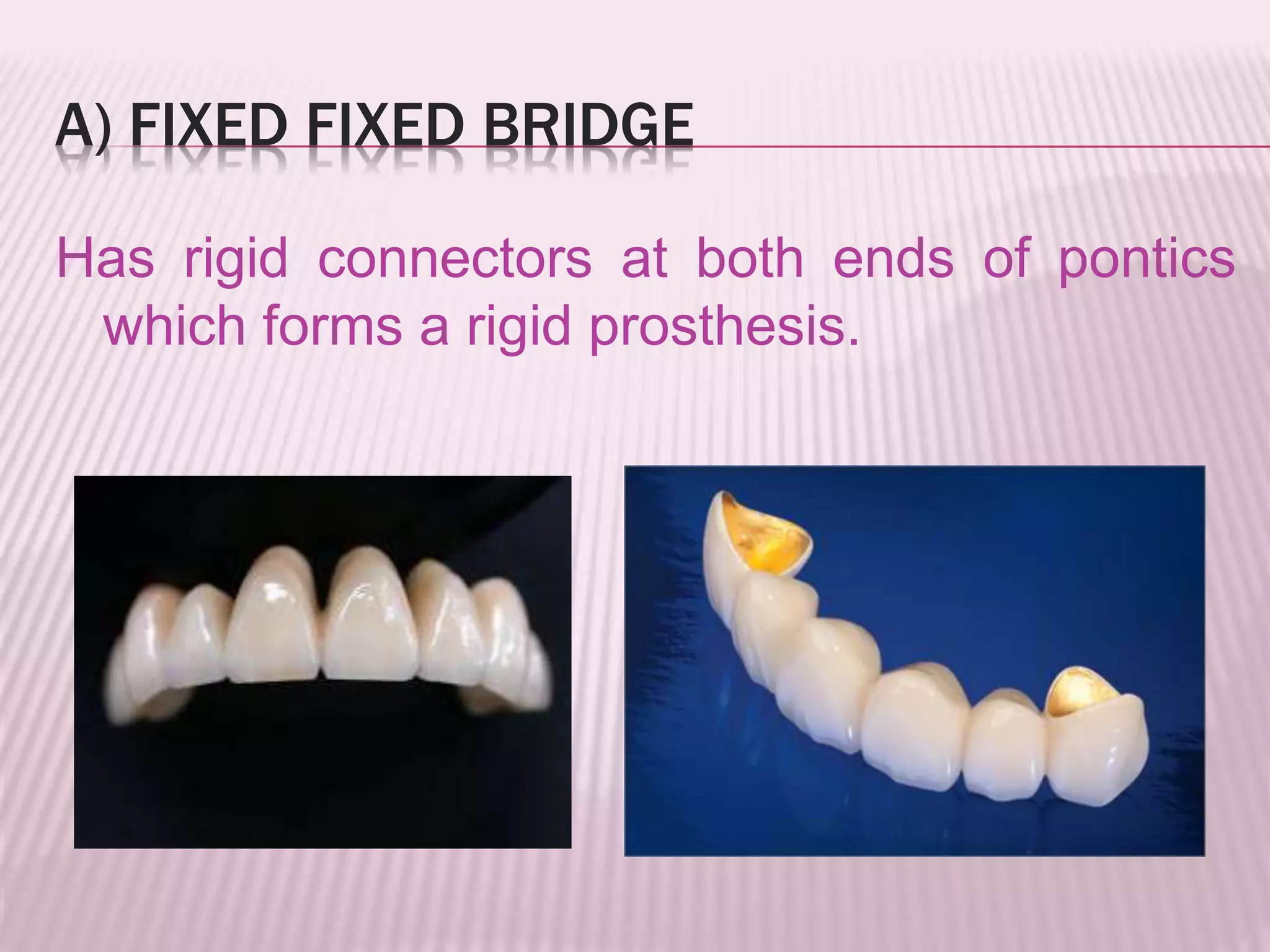 A) FIXED FIXED BRIDGE 
Has rigid connectors at both ends of pontics 
which forms a rigid prosthesis. 
 