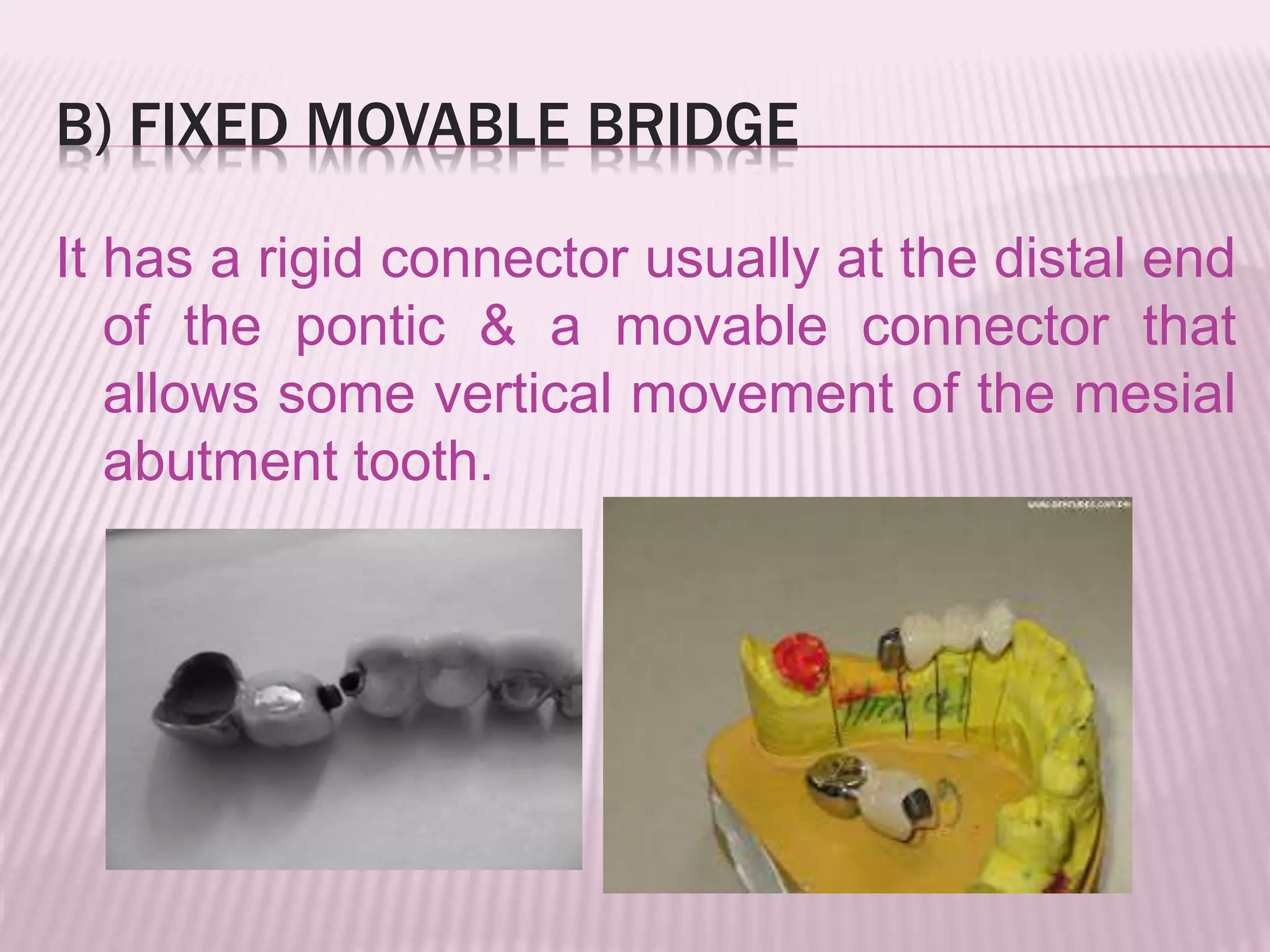 B) FIXED MOVABLE BRIDGE 
It has a rigid connector usually at the distal end 
of the pontic & a movable connector that 
allows some vertical movement of the mesial 
abutment tooth. 
 