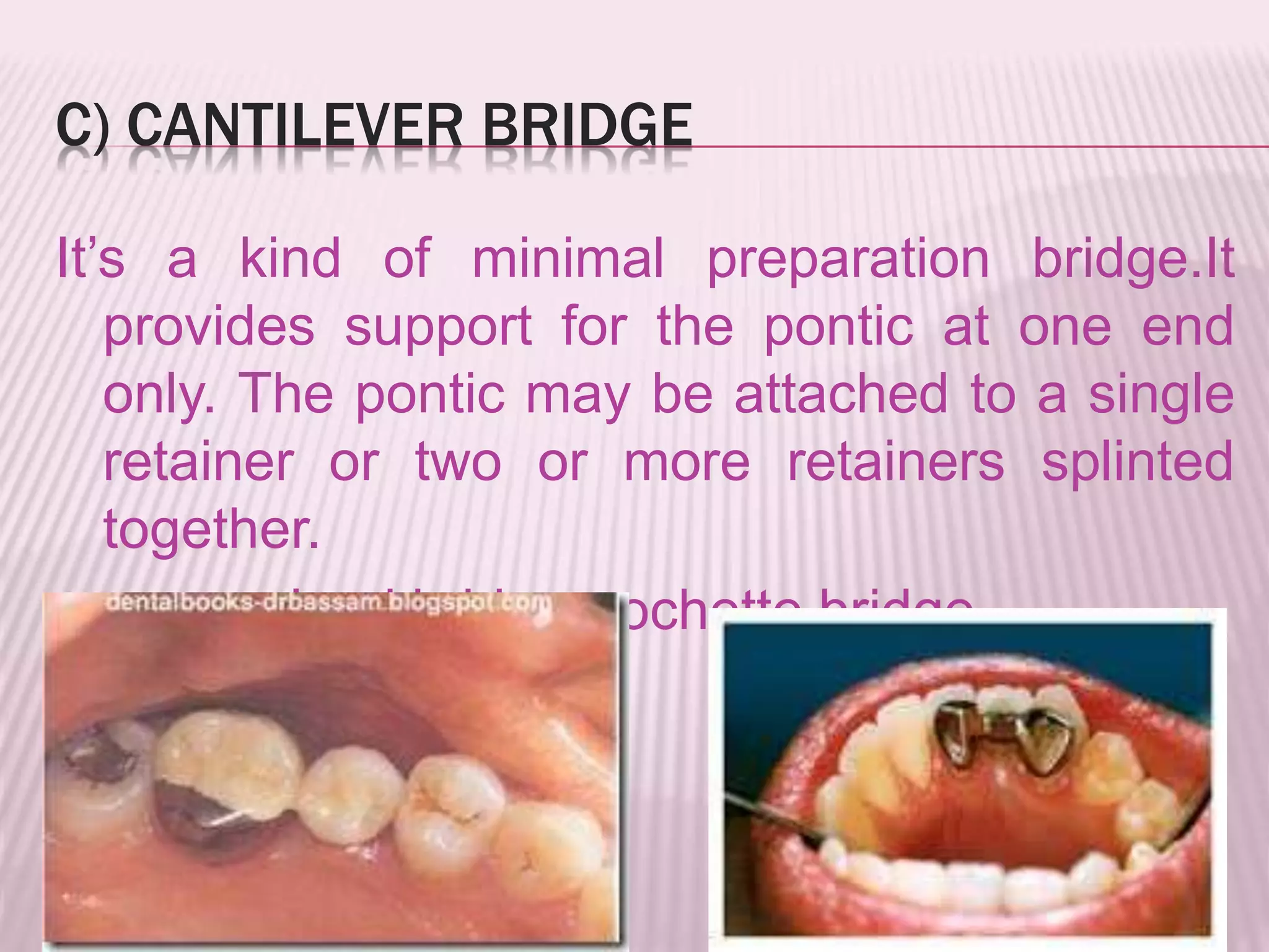 C) CANTILEVER BRIDGE 
It’s a kind of minimal preparation bridge.It 
provides support for the pontic at one end 
only. The pontic may be attached to a single 
retainer or two or more retainers splinted 
together. 
e.g: maryland bridge, rochette bridge 
 