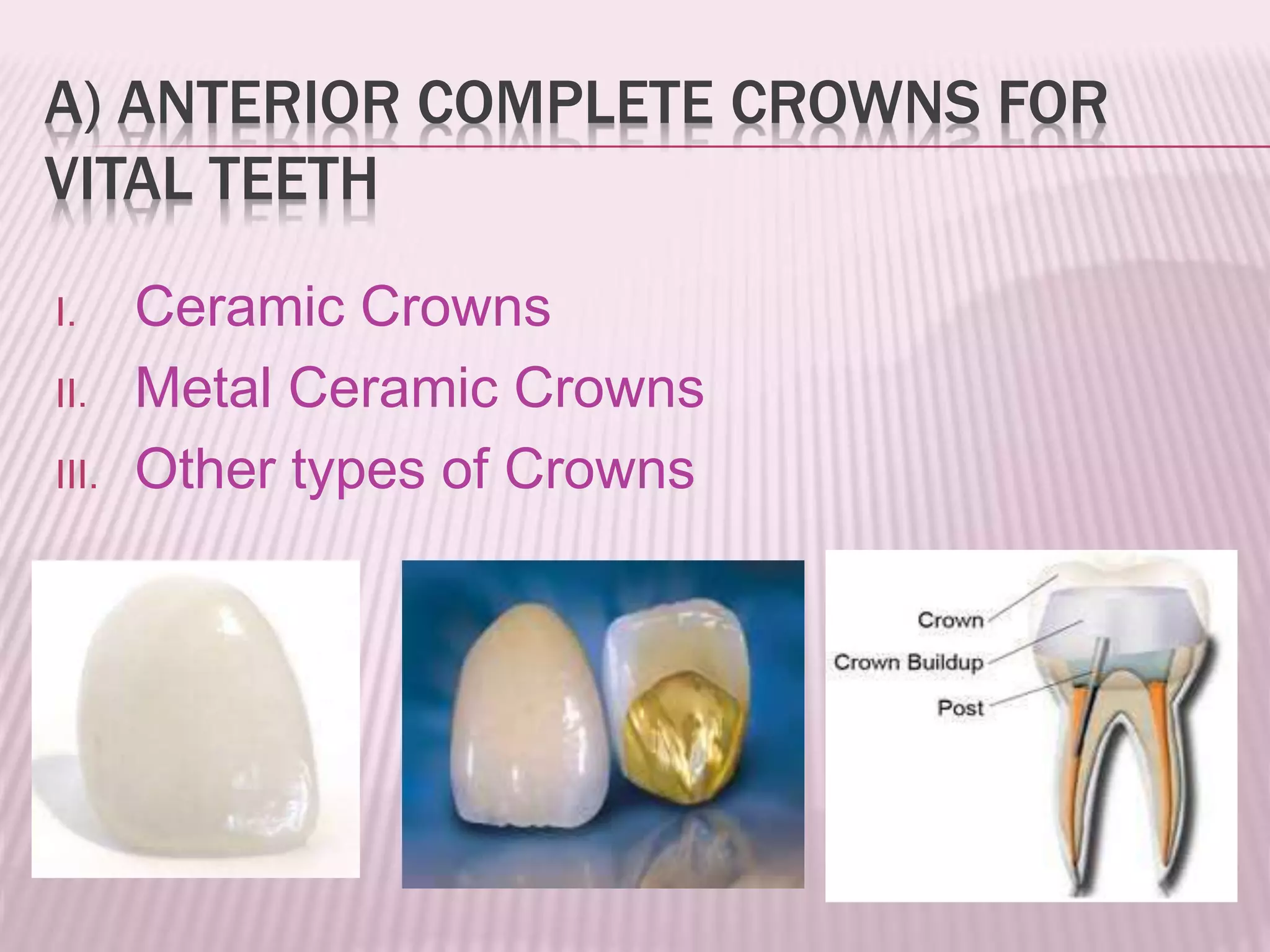 A) ANTERIOR COMPLETE CROWNS FOR 
VITAL TEETH 
I. Ceramic Crowns 
II. Metal Ceramic Crowns 
III. Other types of Crowns 
 