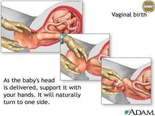 Types of delivery And Physiotherapy management after c-section.pptx