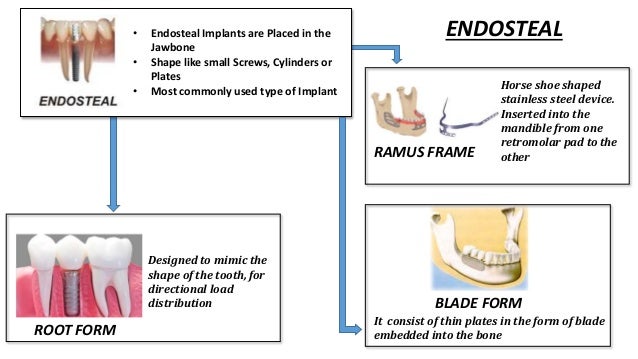 types of dental implants