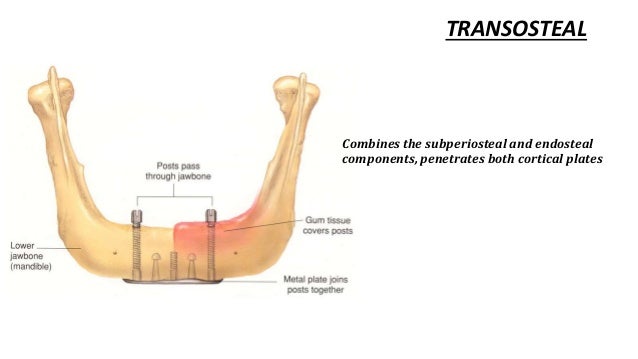 types of dental implant endosteal implant