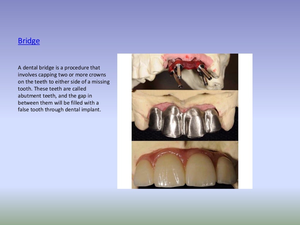 Types of dental prosthesis