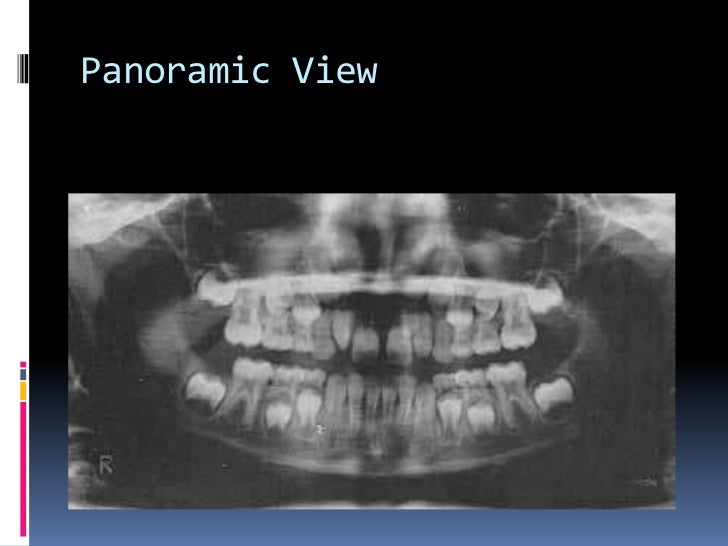 Types of dental radiographs in children