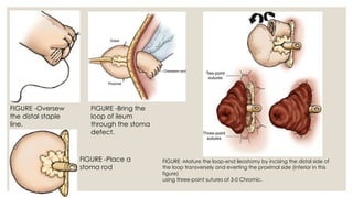 Types of enterostomy and its indications and complications.pptx