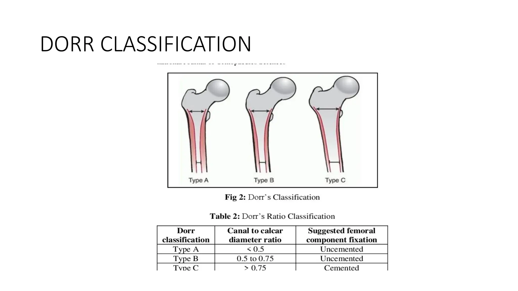 TYPES OF FEMORAL STEMS.pptx for arthropoasty | PPT