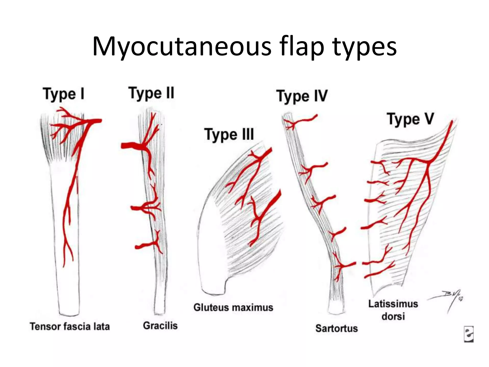 Myocutaneous flap types
 