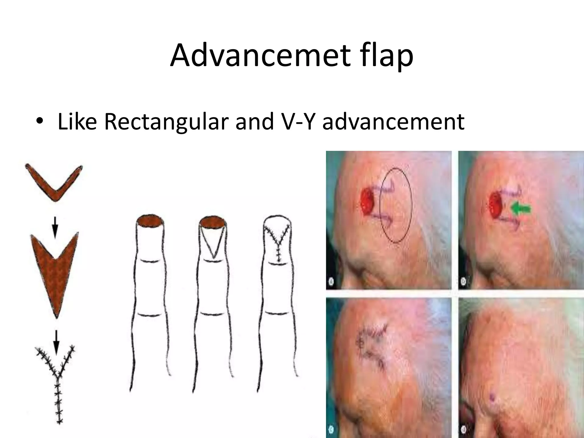 Advancemet flap
• Like Rectangular and V-Y advancement
 