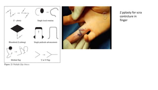 Z pplasty for scra
contrcture in
finger
 