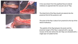 A line was drawn from the popliteal fossa to lateral
malleolus to approximate the vascular axis of flap.
The distal limit of the flap should not extend into the
proximal third of the posterior calf.
The pivot of the flap is about 5cm proximal to the tip of the
lateral malleolous.
The pedicle of the flap between the pivot and the
proximal margin of the flap is exposed with a zig zag
incision of the skin where the skin flaps are elevated with a
single layer of subdermal fat
 