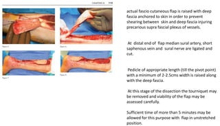 actual fascio cutaneous flap is raised with deep
fascia anchored to skin in order to prevent
shearing between skin and deep fascia injuring
precarious supra fascial plexus of vessels.
At distal end of flap median sural artery, short
saphenous vein and sural nerve are ligated and
cut.
Pedicle of appropriate length (till the pivot point)
with a minimum of 2-2.5cms width is raised along
with the deep fascia.
At this stage of the dissection the tourniquet may
be removed and viability of the flap may be
assessed carefully.
Sufficient time of more than 5 minutes may be
allowed for this purpose with flap in unstretched
position.
 