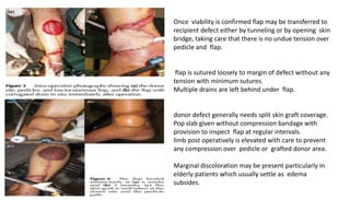 Once viability is confirmed flap may be transferred to
recipient defect either by tunneling or by opening skin
bridge, taking care that there is no undue tension over
pedicle and flap.
flap is sutured loosely to margin of defect without any
tension with minimum sutures.
Multiple drains are left behind under flap.
donor defect generally needs split skin graft coverage.
Pop slab given without compression bandage with
provision to inspect flap at regular intervals.
limb post operatively is elevated with care to prevent
any compression over pedicle or grafted donor area.
Marginal discoloration may be present particularly in
elderly patients which usually settle as edema
subsides.
 