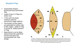 Keystone Flap
• trapezoidal-shaped
fasciocutaneous perforator
flap,
• made of two V-Y flaps on
either end
• It fits well into body
contours and can
reconstruct larger defects.
• The borders of the defect
are extended on either side
to 90° angles, width of flap
is similar to widest portion
of flap.
• deep fascia is cut to allow
advancement & superficial
nerves and veins are
incorporated into flap
design.
 