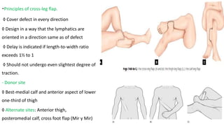 -Principles of cross-leg flap.
◊ Cover defect in every direction
◊ Design in a way that the lymphatics are
oriented in a direction same as of defect
◊ Delay is indicated if length-to-width ratio
exceeds 1½ to 1
◊ Should not undergo even slightest degree of
traction.
- Donor site
◊ Best-medial calf and anterior aspect of lower
one-third of thigh
◊ Alternate sites: Anterior thigh,
posteromedial calf, cross foot flap (Mir y Mir)
 