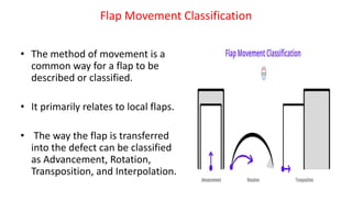 Flap Movement Classification
• The method of movement is a
common way for a flap to be
described or classified.
• It primarily relates to local flaps.
• The way the flap is transferred
into the defect can be classified
as Advancement, Rotation,
Transposition, and Interpolation.
 