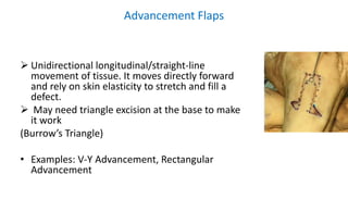 Advancement Flaps
 Unidirectional longitudinal/straight-line
movement of tissue. It moves directly forward
and rely on skin elasticity to stretch and fill a
defect.
 May need triangle excision at the base to make
it work
(Burrow’s Triangle)
• Examples: V-Y Advancement, Rectangular
Advancement
 