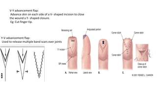 V-Y advancement flap:
Advance skin on each side of a V- shaped incision to close
the wound a Y- shaped closure.
Eg: Cut finger tip.
Y-V advancement flap:
Used to release multiple band scars over joints
 
