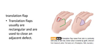 translation flap
• Translation flaps
usually are
rectangular and are
used to close an
adjacent defect.
 