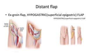 Distant flap
• Ex-groin flap, HYPOGASTRIC(superficial epigastric) FLAP
HYPOGASTRIC(superficial epigastric) FLAP
 