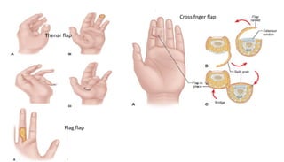 Thenar flap
Cross fnger flap
Flag flap
 