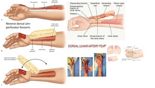 Reverse dorsal ulnr
perforator forearm.
 