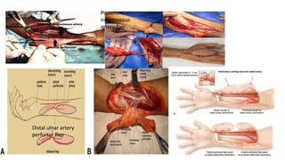 Posteror
interosseous
artery flap
Distal ulnar artery
perfortor flap
 
