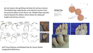 Journal of Hand Surgery
Soft Tissue Release and Bilobed Flap for Severe Radial Longitudinal Deficiency - Journal of Hand Surgery
Soft Tissue Release and Bilobed Flap for Severe Radial
Longitudinal Deficiency
do not require skin grafting and allow for primary closure.
The bilobed flap redistributes and redirects tension from
the primary defect to the donor site. Bilobed flaps typically
extend beyond the defect, which allows for adequate
length and primary closure.
 