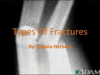 Types Of Fractures By: Taquia Herbert 
