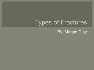 Types of Fractures By: Megan Clay 