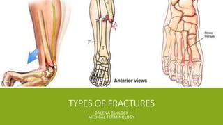 TYPES OF FRACTURES 
DALENA BULLOCK 
MEDICAL TERMINOLOGY 
 