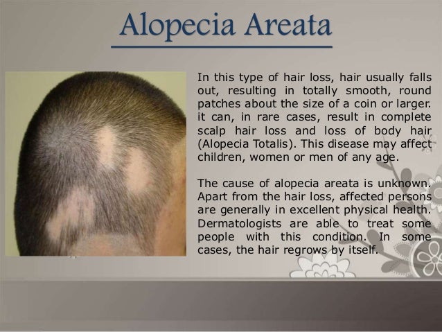 Types Of Hair Loss Cindycut