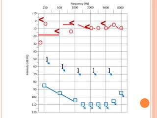 Frequency (Hz)
1000 2000 4000 8000
-10
Intensity(dBHL)
0
10
20
30
40
50
60
70
80
90
100
110
120





250 500
<O
<
O
<
O
<O O O
O
O
<
   
]
]
] ] ]
 