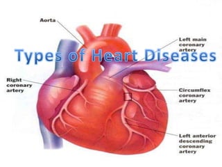 Types of Heart Diseases
 
