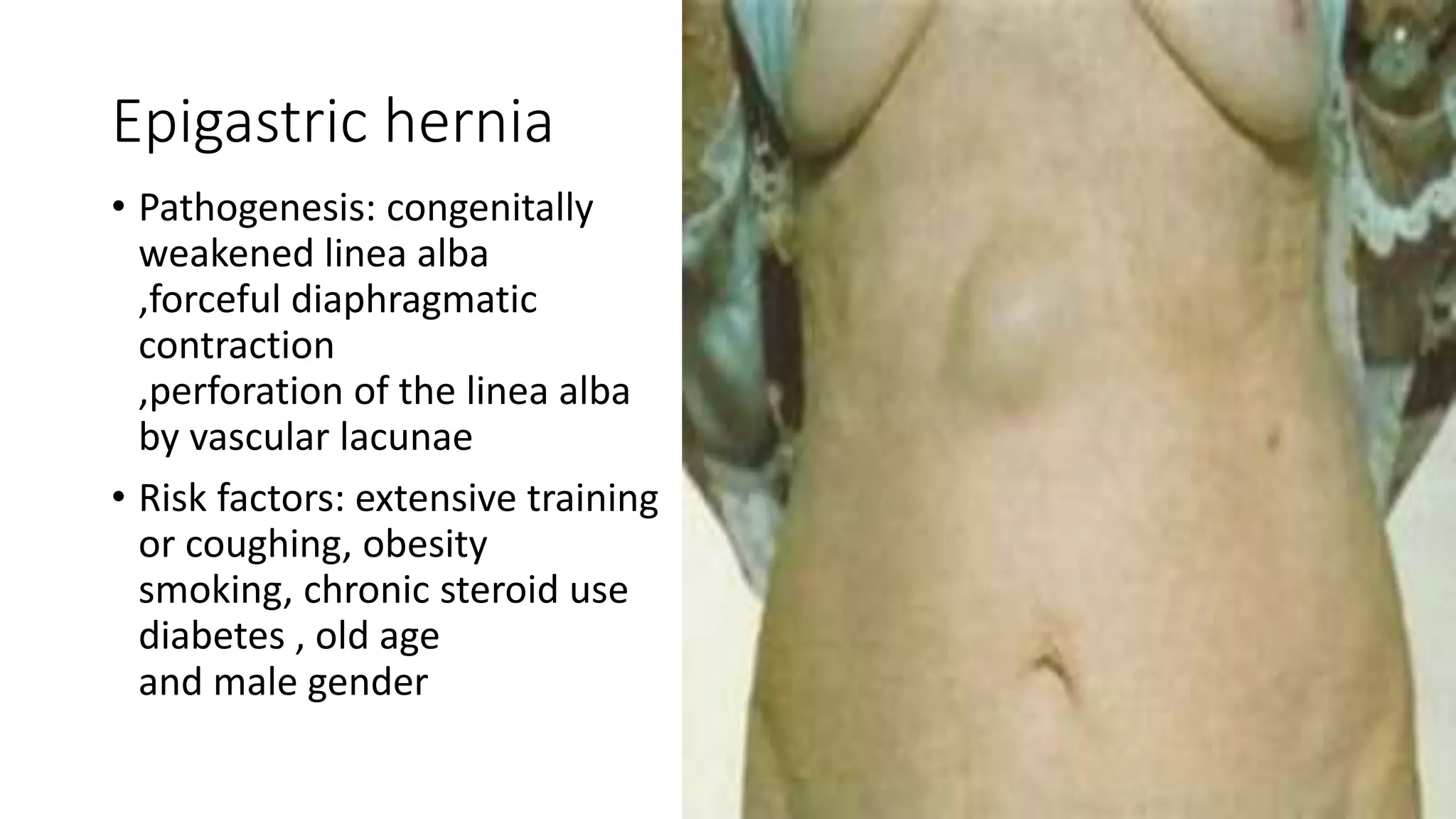 Types of hernia.pptx