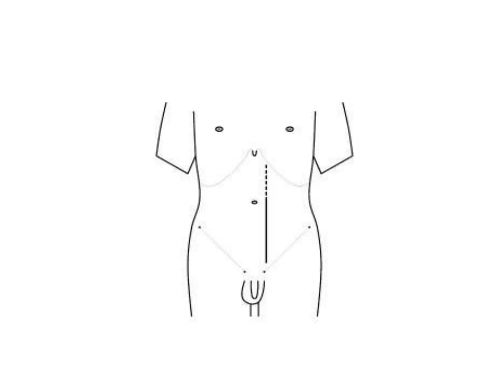 Incision Wikipedia TYPES OF INCISIONS. presentation lecture | PPTX