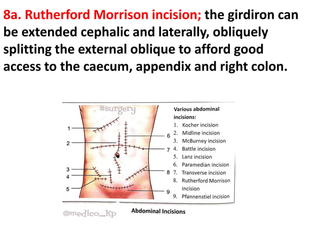 TYPES OF INCISIONS Presentation Lecture PPTX types-of-incisions-presentation-lecture-pptx